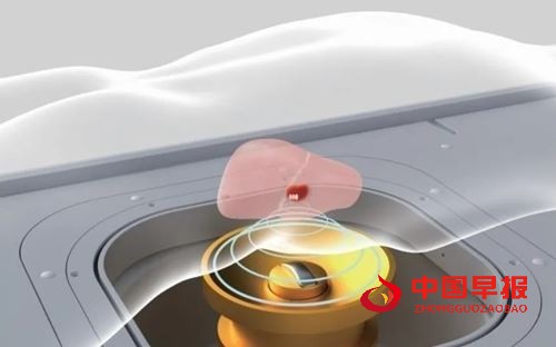 关爱健康，无创守护 | 苏州名仕医院“高强度超声聚焦无创治疗"筛查活动开启(图3)